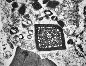 M,58y. | crystalline inclusions in hepatocyte after unknown medication